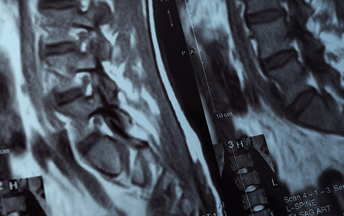 Percutaneous Kyphoplasty