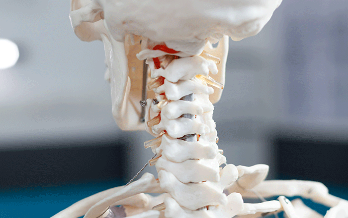 Lumbar Decompression Fusion